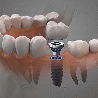 Dental implant in Denver