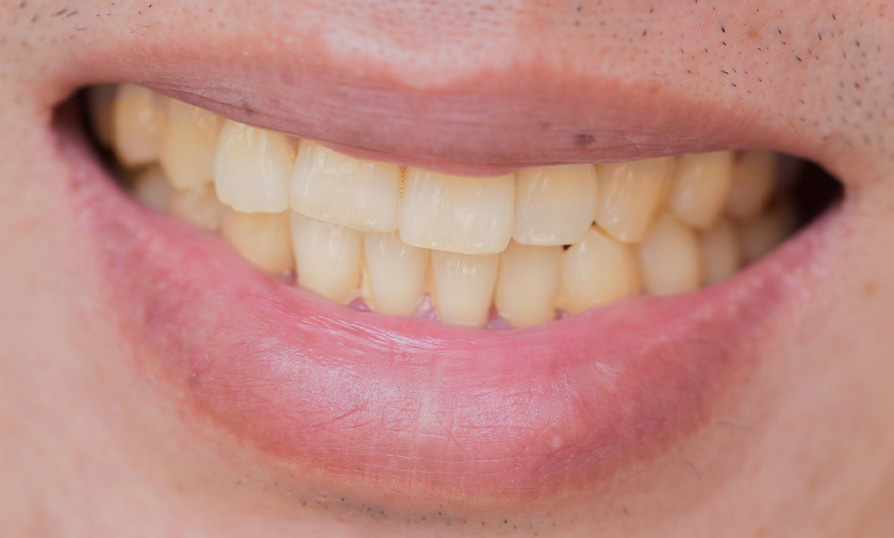 a closeup of a person’s stained teeth