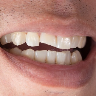 chipped tooth