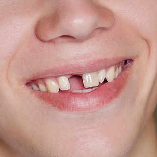 knocked out tooth