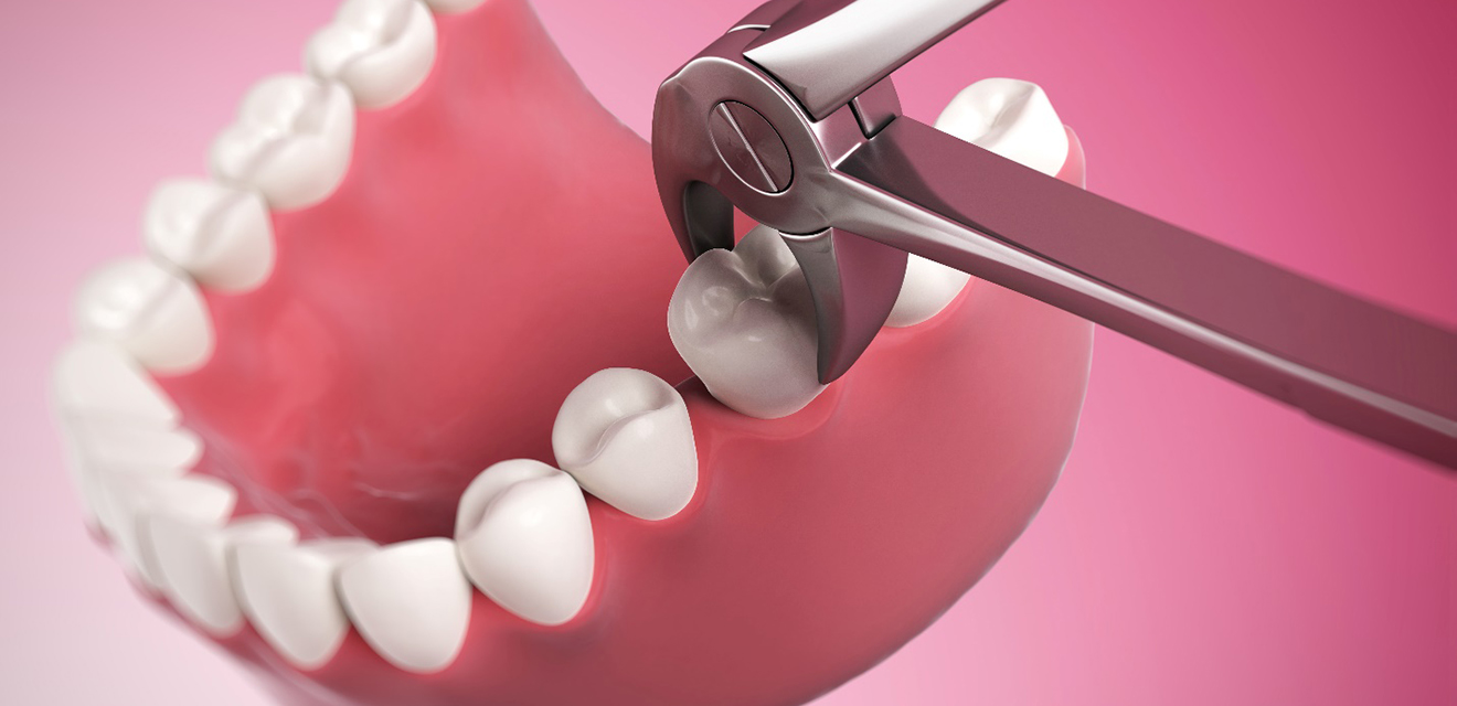 3D render of a tooth extraction