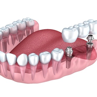 Dental implant bridge in Denver