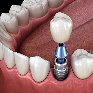 Model showing parts of a dental implant