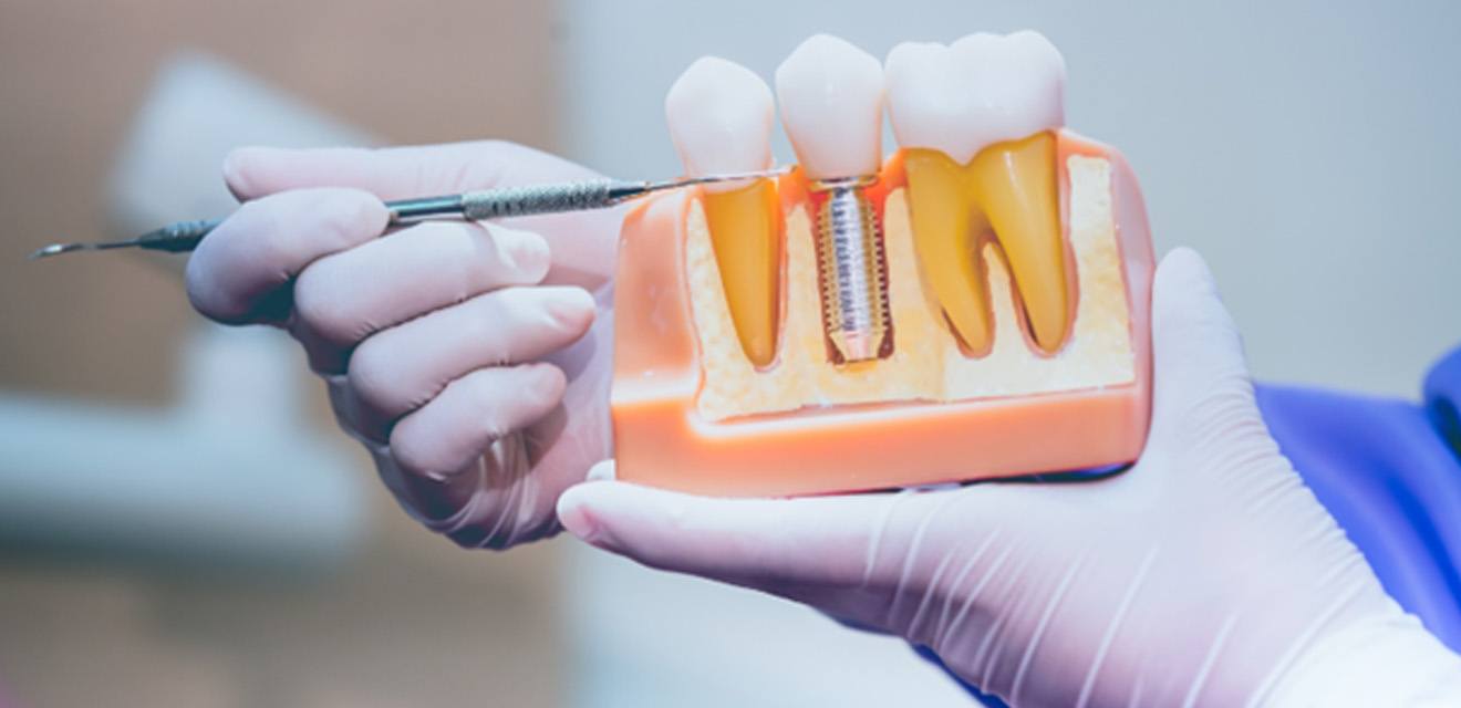 Dentist pointing to a dental implant model