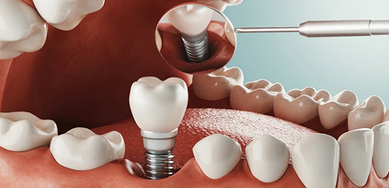 How dental implants work in Denver