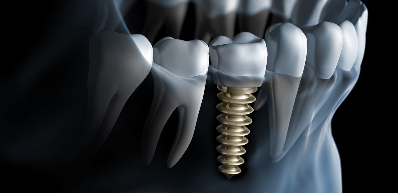 X-ray diagram showing how dental implants in Denver work