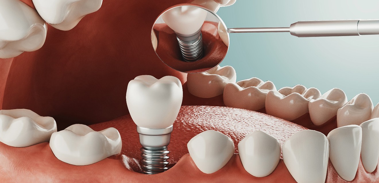 man with missing tooth being sized for implant