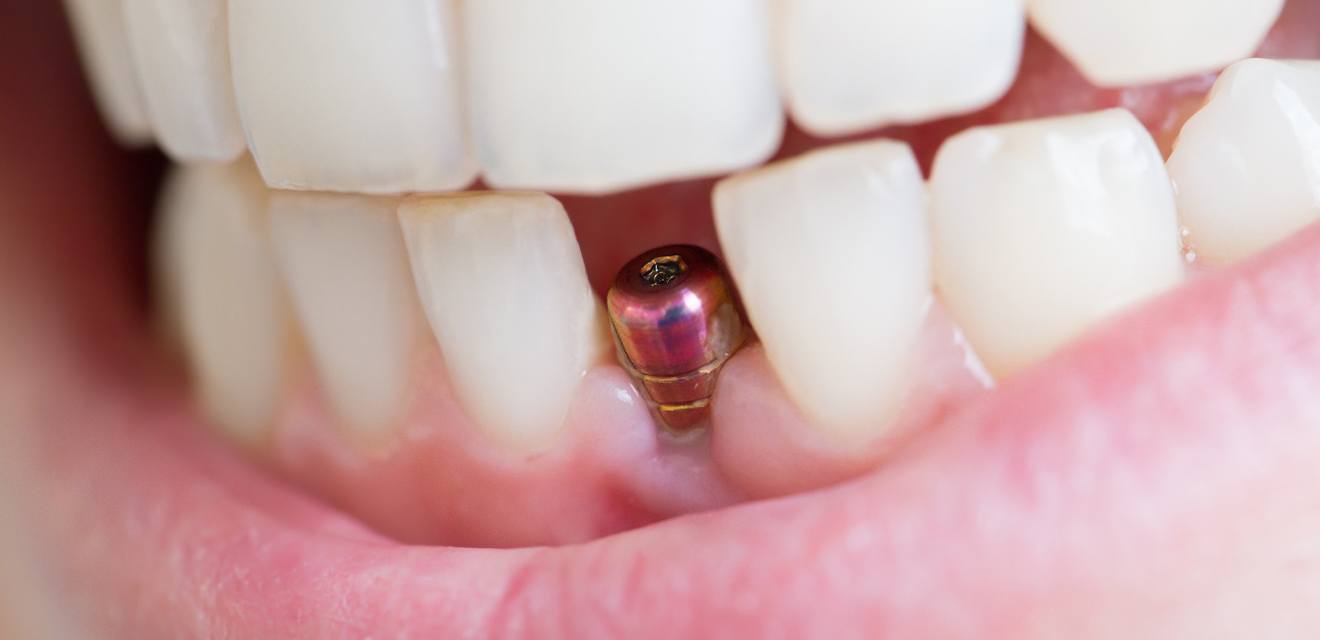 Closeup of patient’s new dental implants in Denver