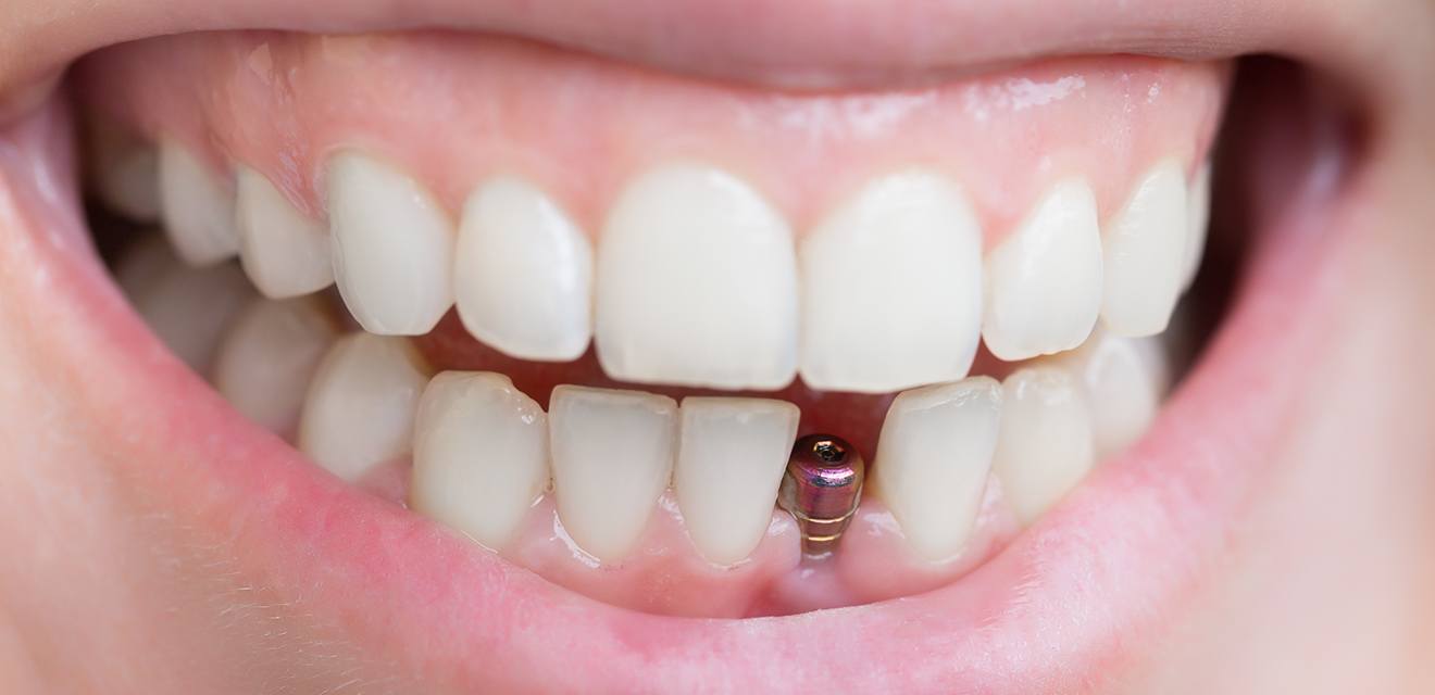 metal dental implant in smile