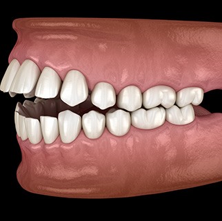 Illustration of an open bite