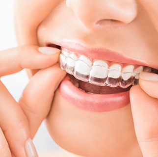 Nose-to-chin closeup of woman inserting Invisalign over upper arch