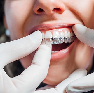 White gloved hands placing Invisalign over woman’s upper teetha