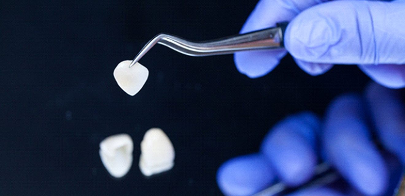 Close up of dentist holding veneer with tweezers