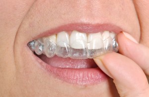 invisalign in denver