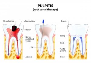 root canal therapy illustration 