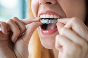 Woman slipping clear aligner onto teeth.